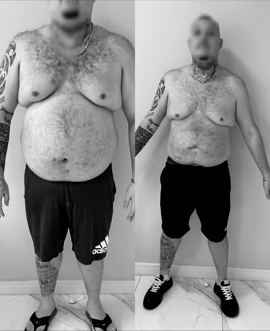 Paciente do Dr. Christian Chaves, antes e depois do acompanhamento de emagrecimento