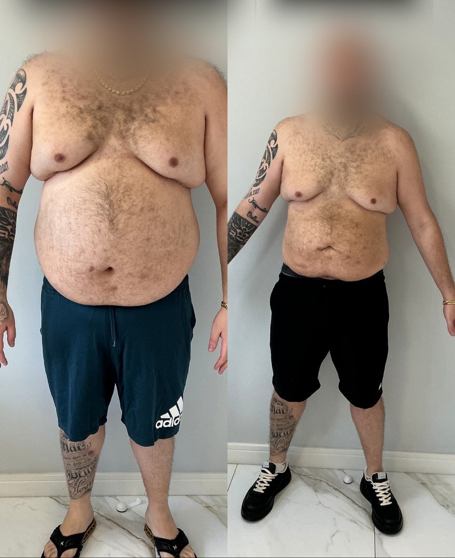 Paciente do Dr. Christian Chaves, antes e depois do acompanhamento de emagrecimento
