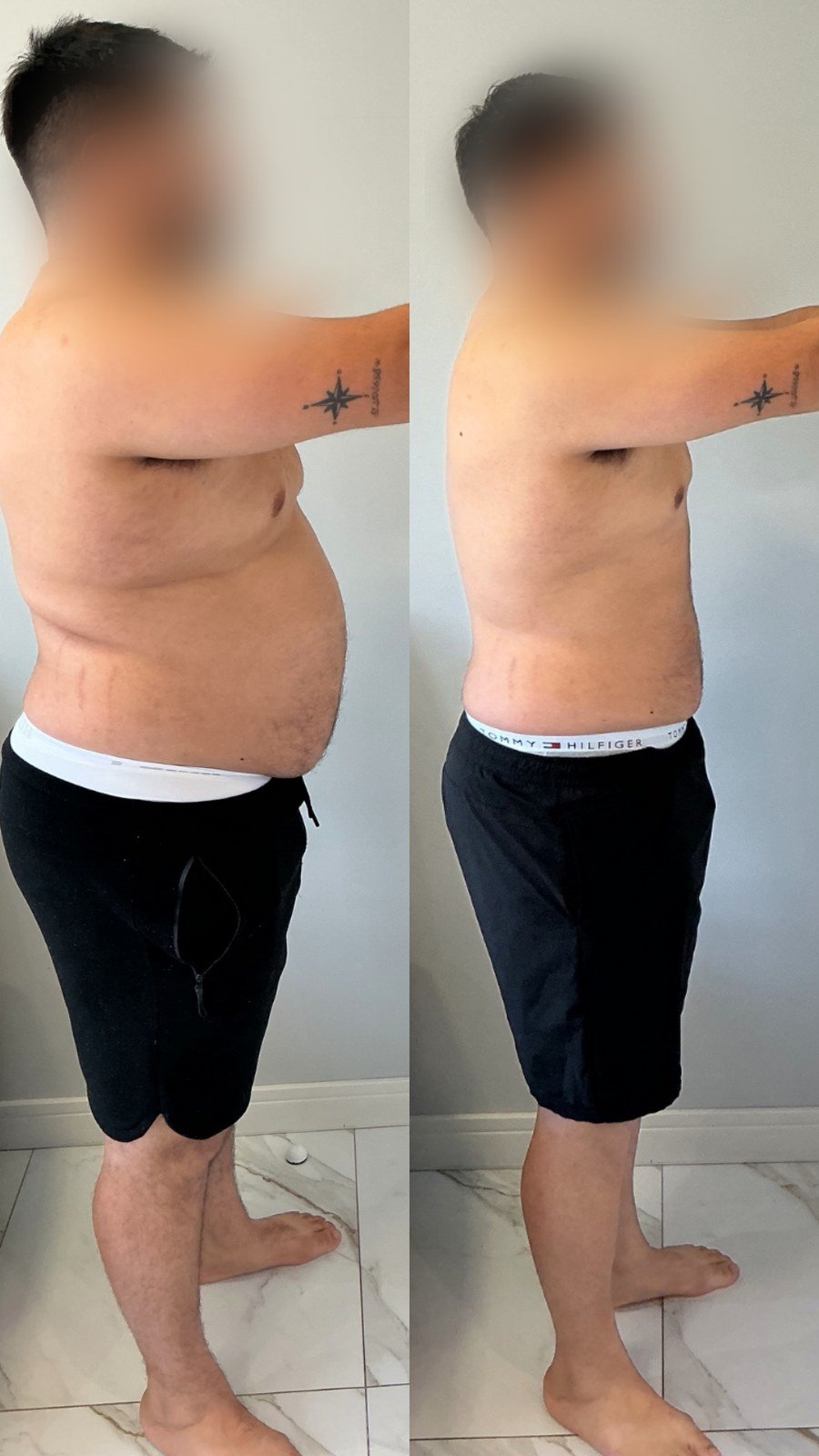 Paciente do Dr. Christian Chaves, antes e depois do acompanhamento de emagrecimento