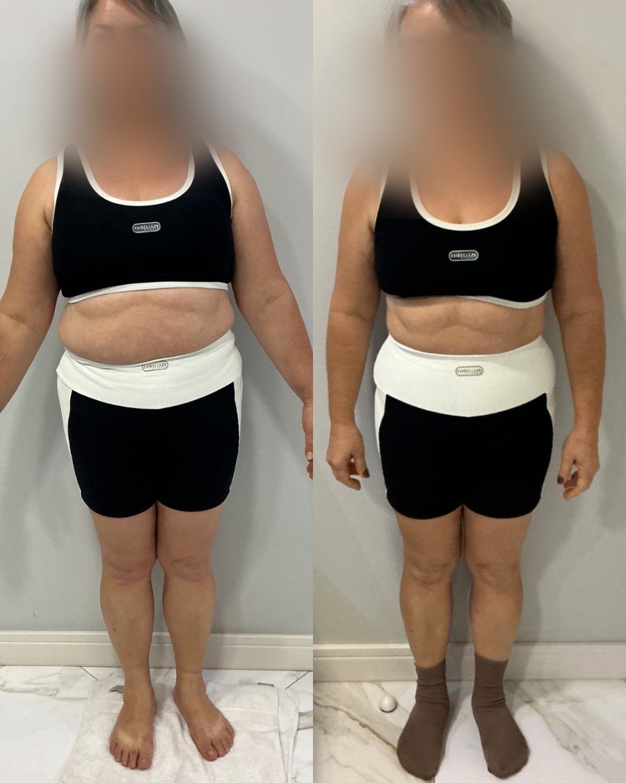 Paciente do Dr. Christian Chaves, antes e depois do acompanhamento de emagrecimento