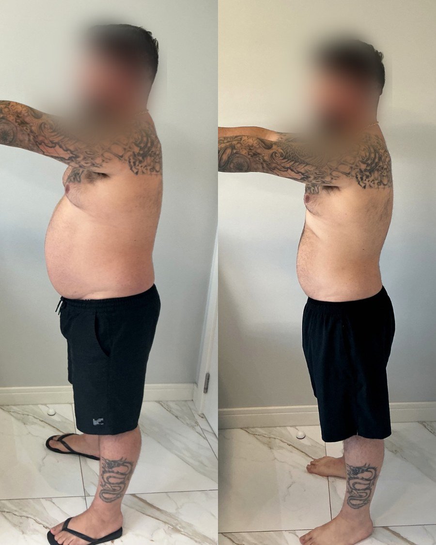 Paciente do Dr. Christian Chaves, antes e depois do acompanhamento de emagrecimento